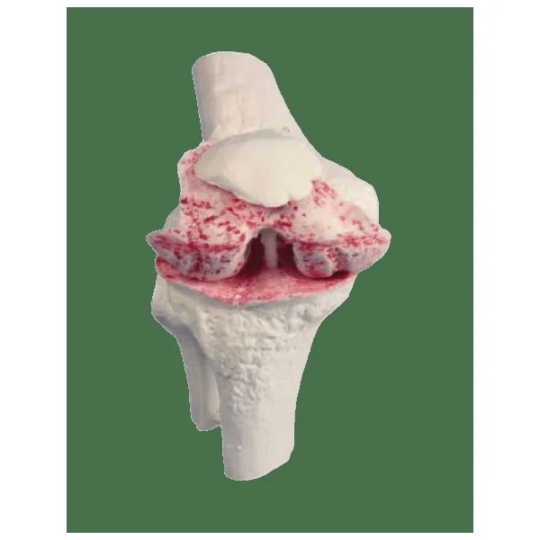 3 Modèles de genou - Sain, malade et avec implant Erler Zimmer 1125