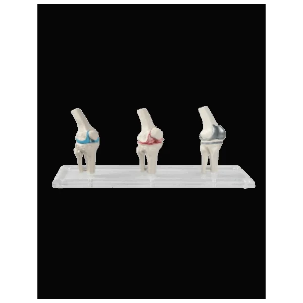 3 Modèles de genou - Sain, malade et avec implant Erler Zimmer 1125