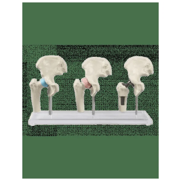 3 Modèles de hanche - Sain, malade et avec implant Erler Zimmer 1115