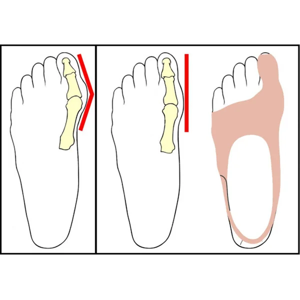 Correcteur d'Hallux-Valgus pour le jour Gourallux